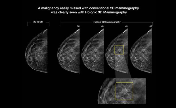 The New Standard of Care in Breast Cancer Screening