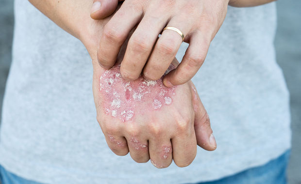 Living with Psoriasis Don t Compare Your Case to Others