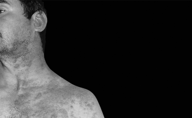 Shingles What You Need To Know